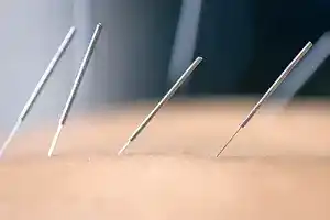 Altın İğne Uygulaması