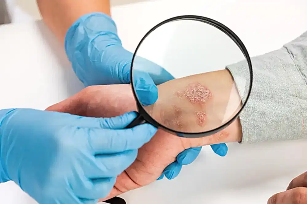 Genital Siğil Ankara HPV Tedavisi