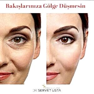 Göz Çevresi Botoksu Ankara