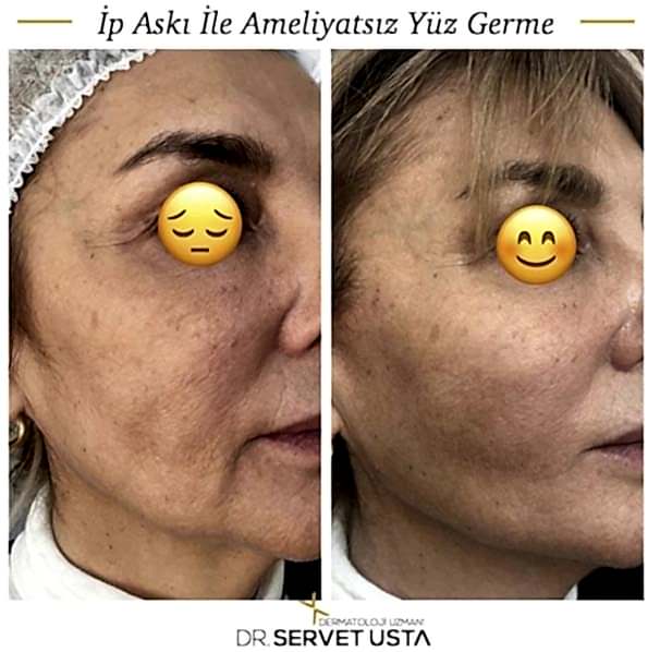 Ameliyatsız Estetik